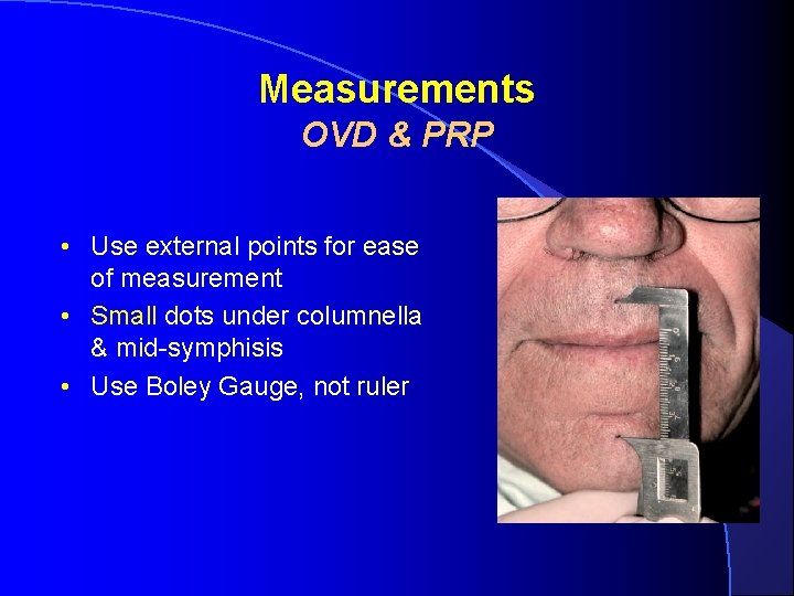 Measurements OVD & PRP • Use external points for ease of measurement • Small