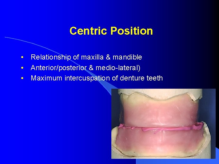 Centric Position • Relationship of maxilla & mandible • Anterior/posterior & medio-lateral) • Maximum