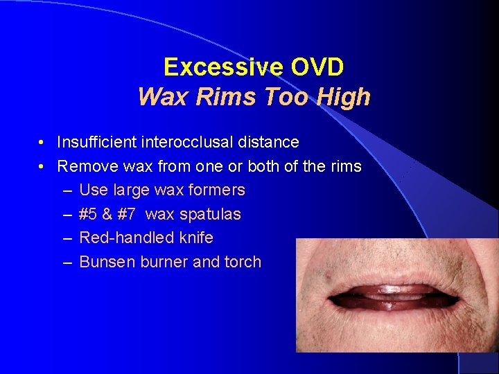 Excessive OVD Wax Rims Too High • Insufficient interocclusal distance • Remove wax from Excessive OVD Wax Rims Too High • Insufficient interocclusal distance • Remove wax from
