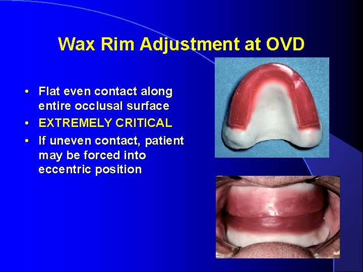 Wax Rim Adjustment at OVD • Flat even contact along entire occlusal surface •