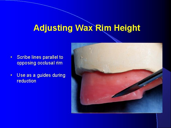 Adjusting Wax Rim Height • Scribe lines parallel to opposing occlusal rim • Use Adjusting Wax Rim Height • Scribe lines parallel to opposing occlusal rim • Use