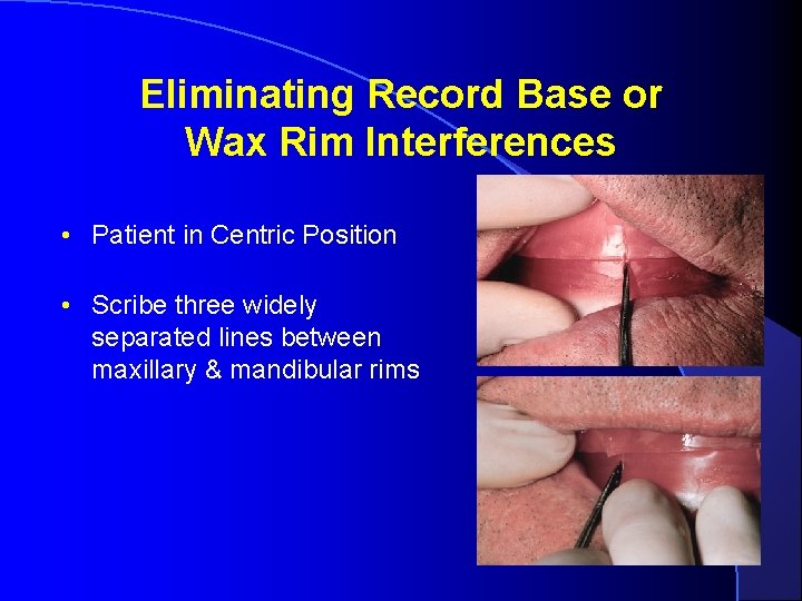 Eliminating Record Base or Wax Rim Interferences • Patient in Centric Position • Scribe
