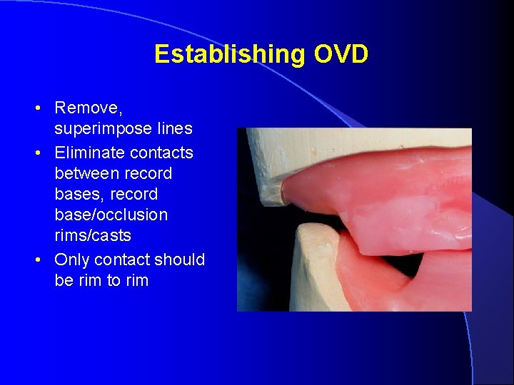 Establishing OVD • Remove, superimpose lines • Eliminate contacts between record bases, record base/occlusion