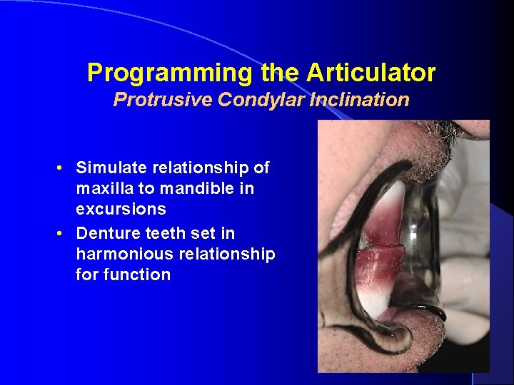 Programming the Articulator Protrusive Condylar Inclination • Simulate relationship of maxilla to mandible in