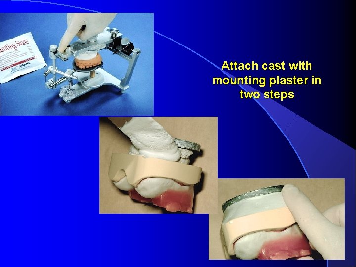 Attach cast with mounting plaster in two steps 