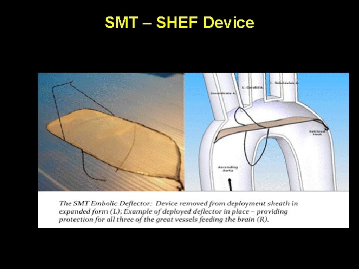 SMT – SHEF Device 