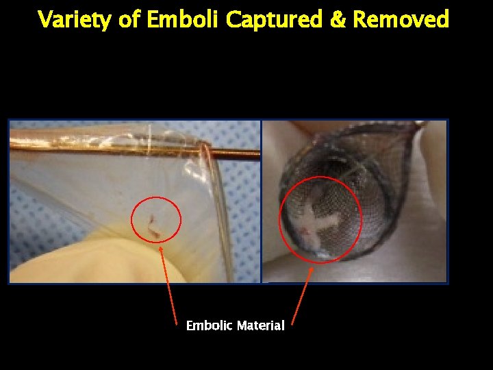 Variety of Emboli Captured & Removed Embolic Material 