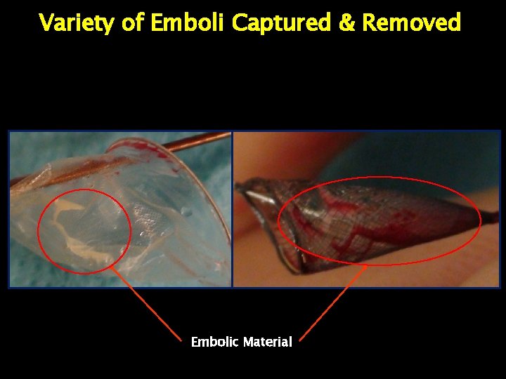 Variety of Emboli Captured & Removed Embolic Material 