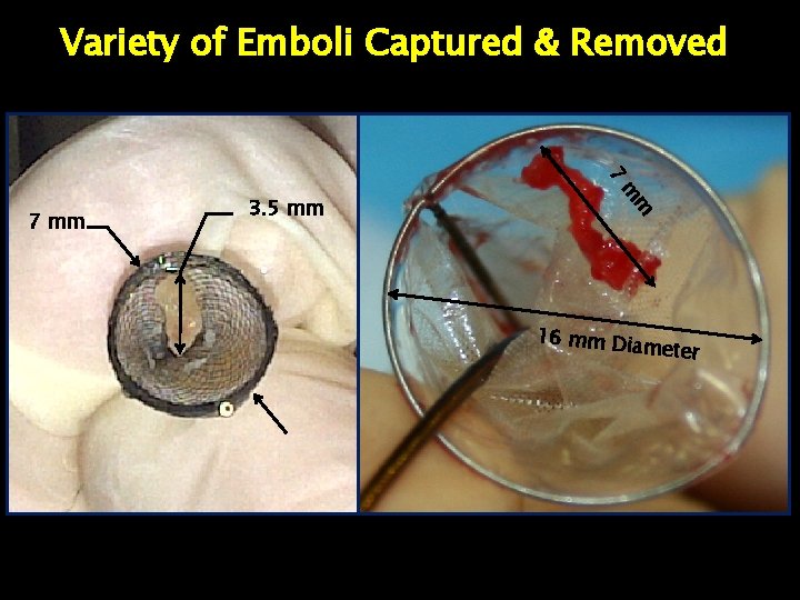 Variety of Emboli Captured & Removed 7 m 3. 5 mm m 7 mm