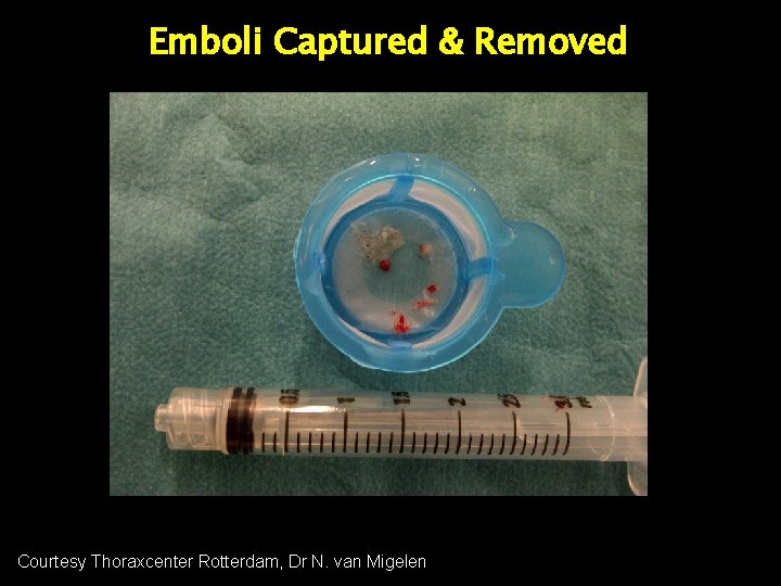 Emboli Captured & Removed 7 m 3. 5 mm m 7 mm 16 mm