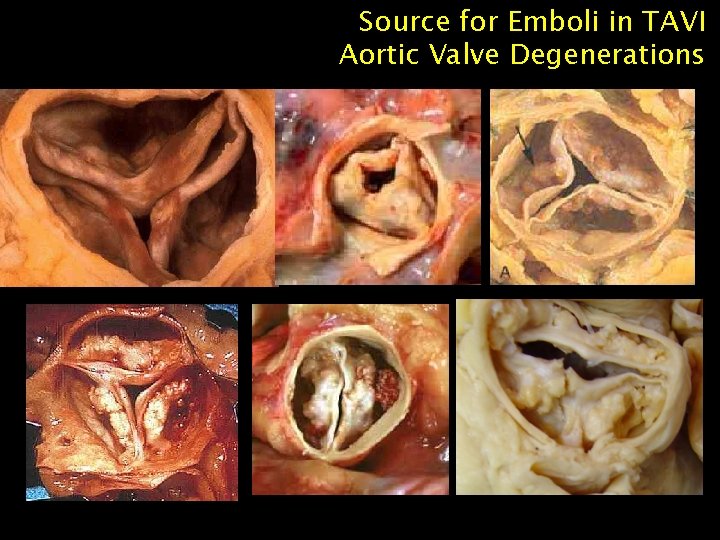 Source for Emboli in TAVI Aortic Valve Degenerations 