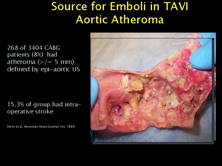 Source for Emboli in TAVI Aortic Atheroma 268 of 3404 CABG patients (8%) had