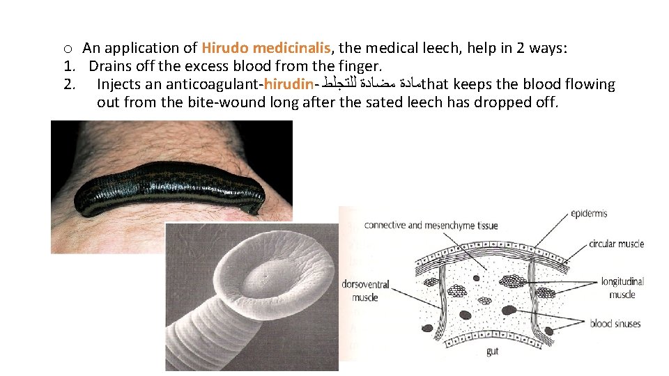 o An application of Hirudo medicinalis, the medical leech, help in 2 ways: 1.