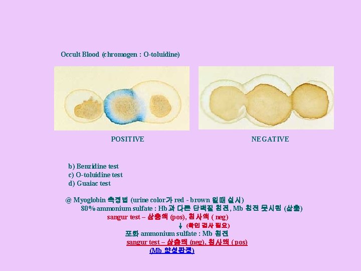 Occult Blood (chromogen : O-toluidine) POSITIVE NEGATIVE b) Benzidine test c) O-toluidine test d)