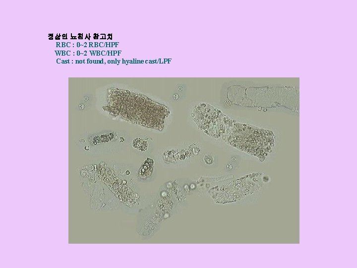 정상인 뇨침사 참고치 RBC : 0~2 RBC/HPF WBC : 0~2 WBC/HPF Cast : not