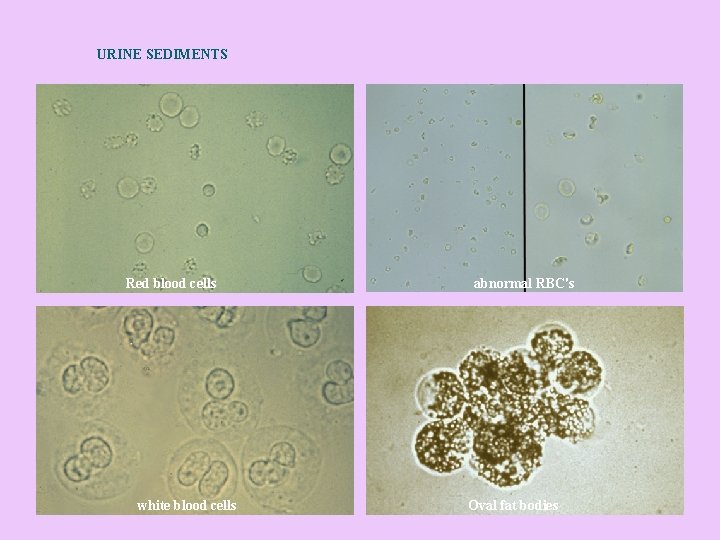 URINE SEDIMENTS Red blood cells white blood cells abnormal RBC's Oval fat bodies 