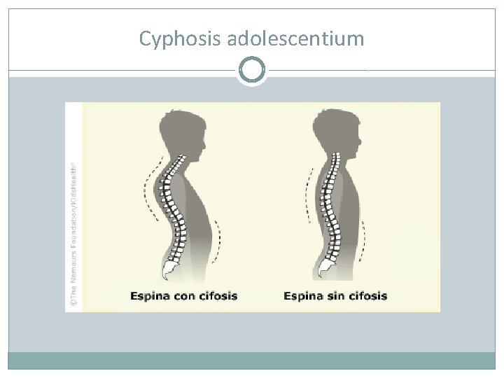 Cyphosis adolescentium 