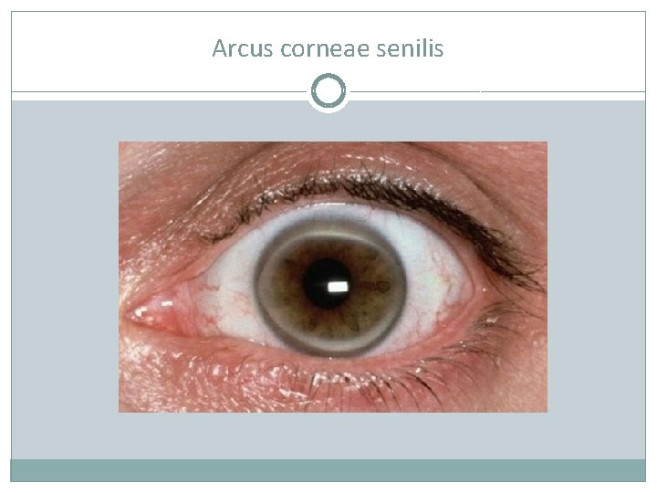 Arcus corneae senilis 