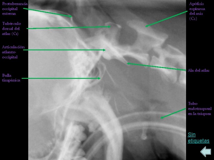 Protuberancia occipital externa Apófisis espinosa del axis (C 2) Tubérculo dorsal del atlas (C