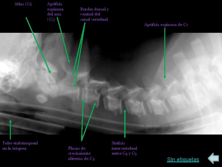 Atlas (C 1) Tubo endotraqueal en la tráquea Apófisis espinosa del axis (C 2)