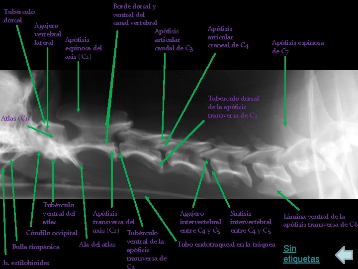 Tubérculo dorsal Agujero vertebral Apófisis lateral espinosa del axis (C 2) Borde dorsal y