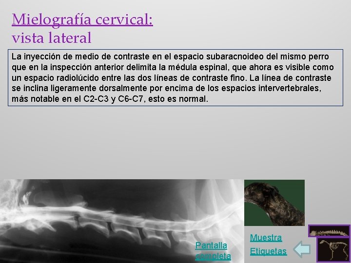 Mielografía cervical: vista lateral La inyección de medio de contraste en el espacio subaracnoideo