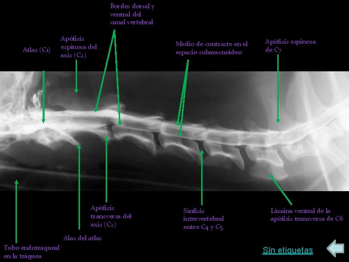 Bordes dorsal y ventral del canal vertebral Atlas (C 1) Apófisis espinosa del axis