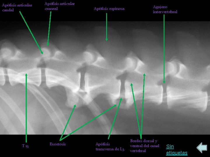 Apófisis articular caudal T 13 Apófisis articular craneal Exostosis Apófisis espinosa Apófisis transversa de