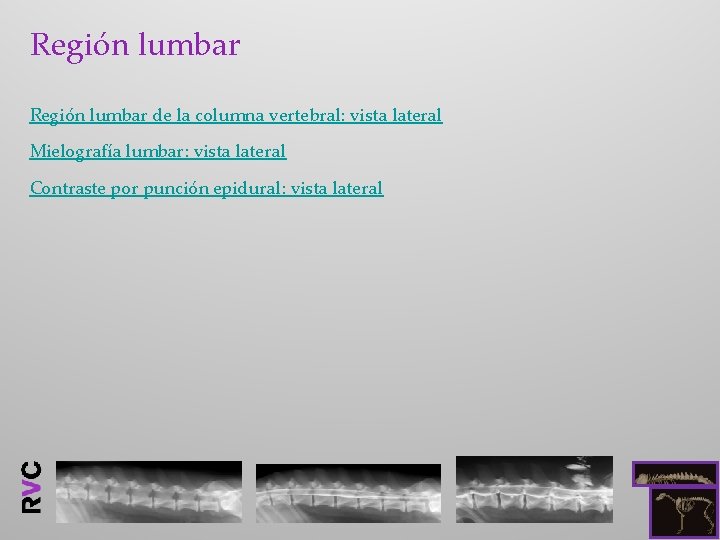 Región lumbar de la columna vertebral: vista lateral Mielografía lumbar: vista lateral Contraste por