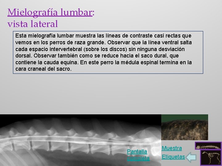 Mielografía lumbar: vista lateral Esta mielografía lumbar muestra las líneas de contraste casi rectas