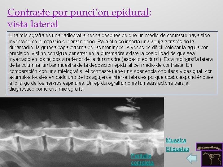 Contraste por punci’on epidural: vista lateral Una mielografía es una radiografía hecha después de