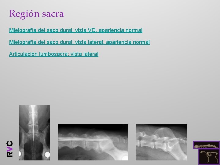 Región sacra Mielografía del saco dural: vista VD, apariencia normal Mielografía del saco dural: