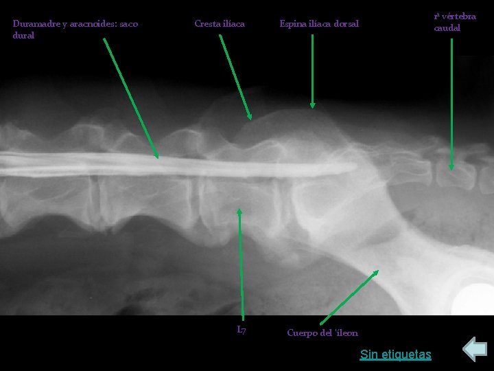 Duramadre y aracnoides: saco dural Cresta ilíaca Espina ilíaca dorsal L 7 Cuerpo del