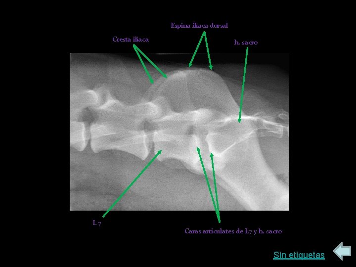 Espina ilíaca dorsal Cresta ilíaca L 7 h. sacro Caras articulates de L 7