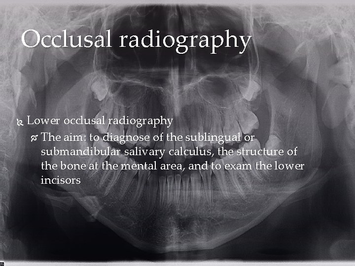 Occlusal radiography Lower occlusal radiography The aim: to diagnose of the sublingual or submandibular