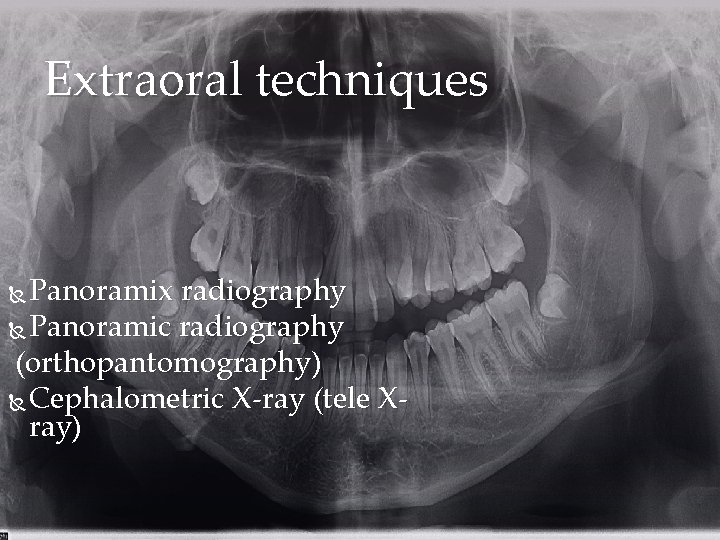 Extraoral techniques Panoramix radiography Panoramic radiography (orthopantomography) Cephalometric X-ray (tele Xray) 