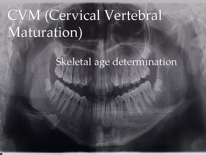 CVM (Cervical Vertebral Maturation) Skeletal age determination 