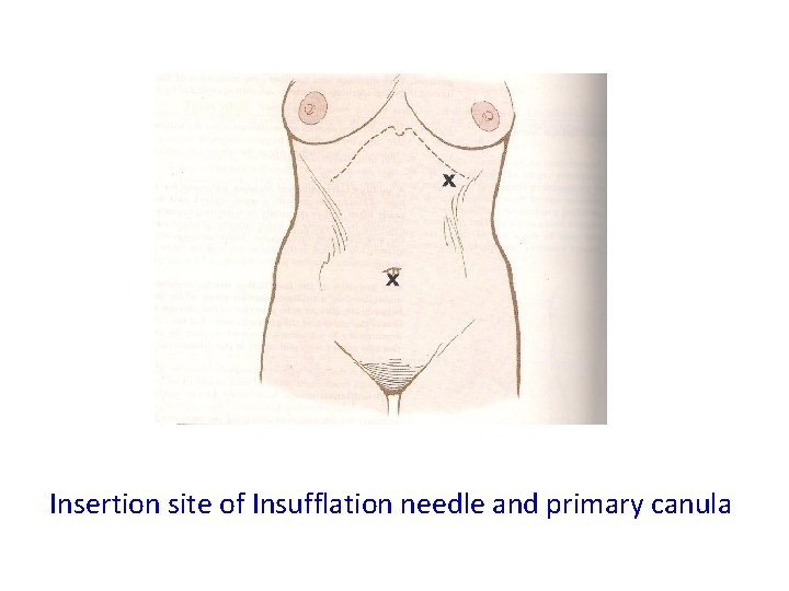 Insertion site of Insufflation needle and primary canula 