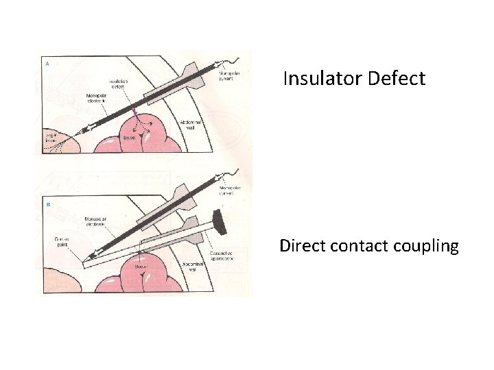 Insulator Defect Direct contact coupling 