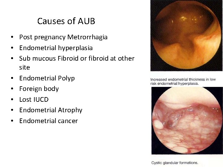 Causes of AUB • Post pregnancy Metrorrhagia • Endometrial hyperplasia • Sub mucous Fibroid