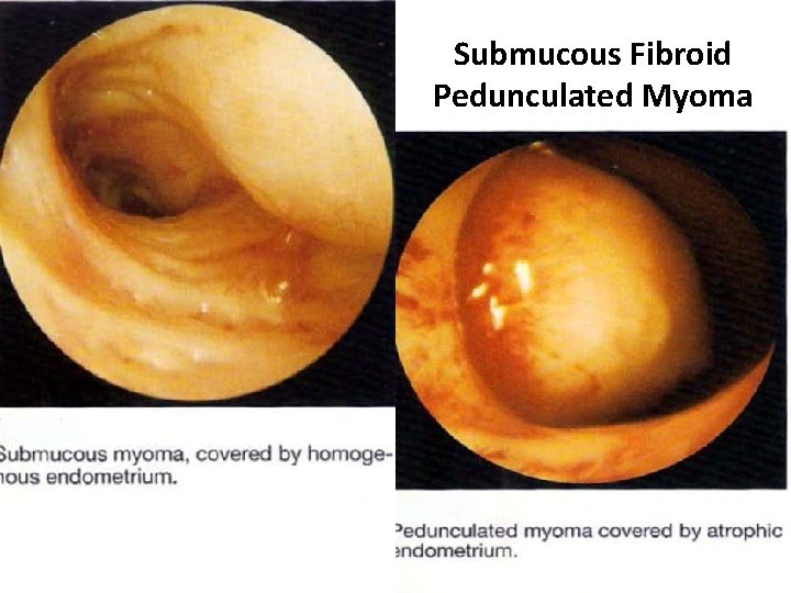 Submucous Fibroid Pedunculated Myoma 