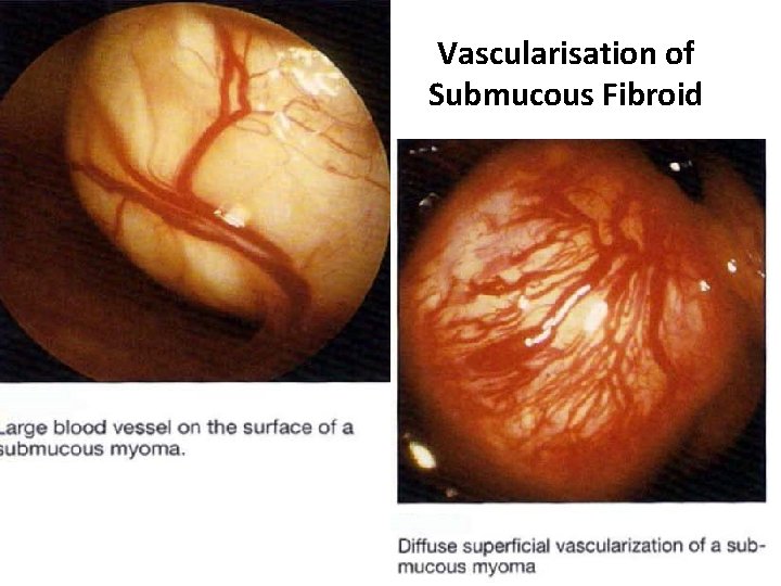 Vascularisation of Submucous Fibroid 