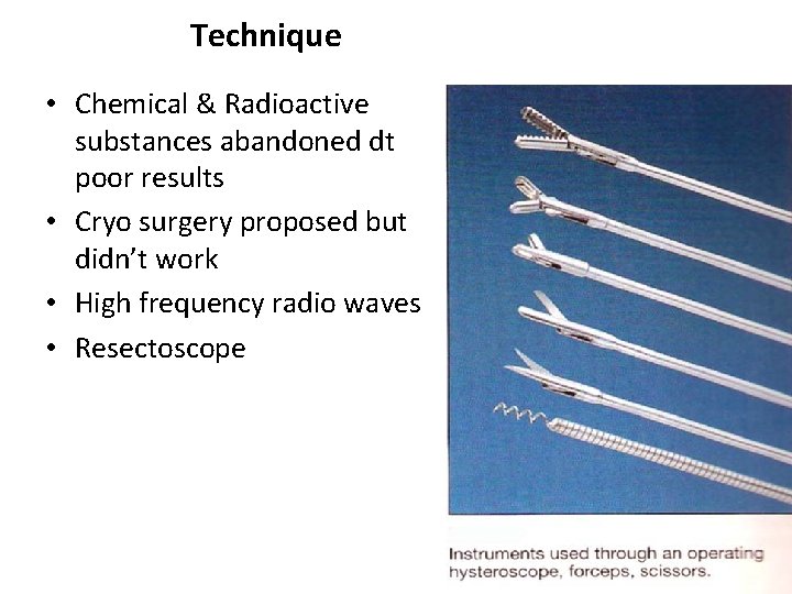 Technique • Chemical & Radioactive substances abandoned dt poor results • Cryo surgery proposed