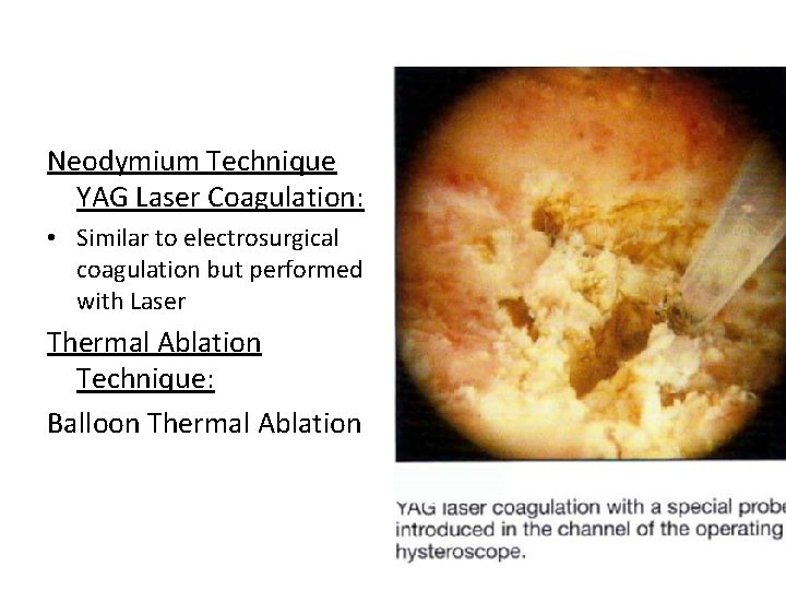 Neodymium Technique YAG Laser Coagulation: • Similar to electrosurgical coagulation but performed with Laser