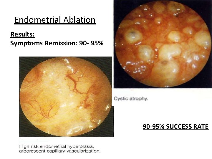 Endometrial Ablation Results: Symptoms Remission: 90 - 95% 90 -95% SUCCESS RATE 