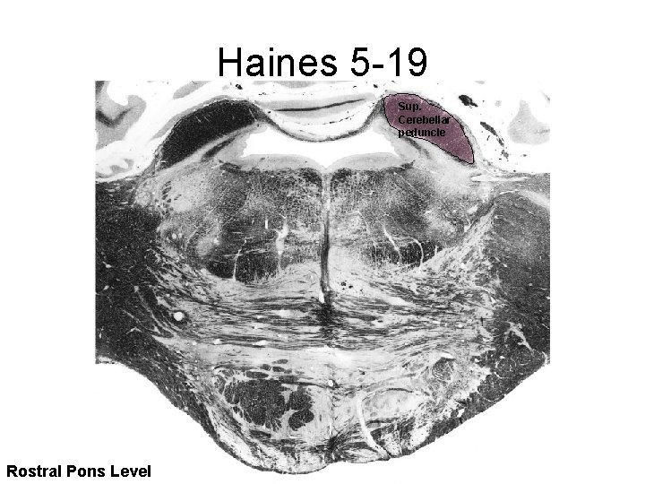 Haines 5 -19 Sup. Cerebellar peduncle Rostral Pons Level 
