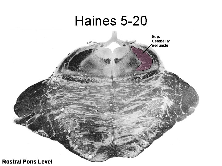 Haines 5 -20 Sup. Cerebellar peduncle Rostral Pons Level 