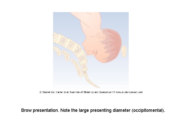 Brow presentation. Note the large presenting diameter (occipitomental). 