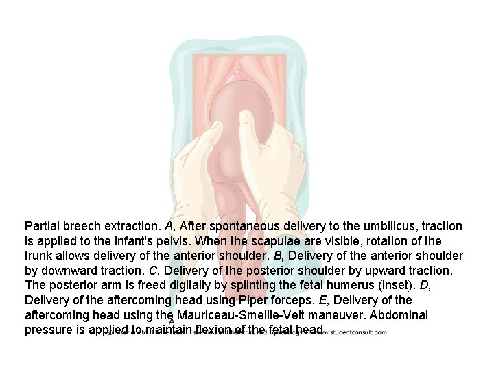 Partial breech extraction. A, After spontaneous delivery to the umbilicus, traction is applied to