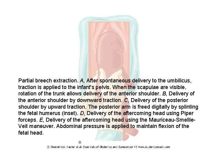 Partial breech extraction. A, After spontaneous delivery to the umbilicus, traction is applied to